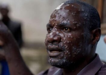 Santé : L&rsquo;OMS alerte sur la recrudescence de cas de Monkey pox en Afrique.